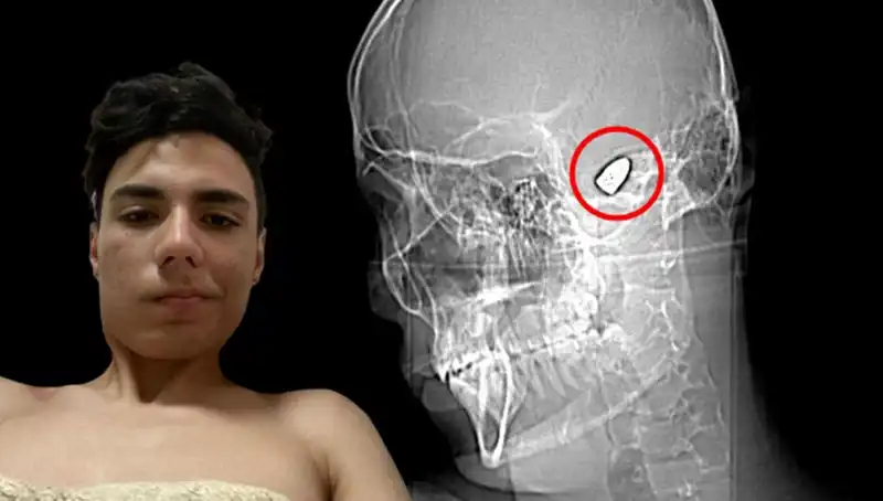 Kafasında Patlamaya Hazır Bomba Taşıyan Genç: Hayatın Kıyısında Bir Mücadele