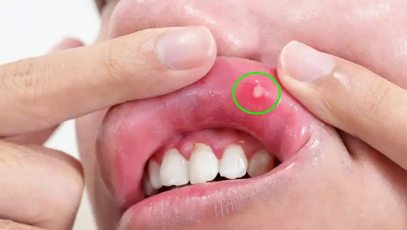 B Vitamini Eksikliği: Belirtileri ve Sağlığınıza Etkileri
