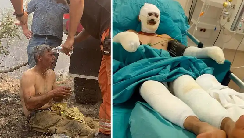 Korkunç Kaza: Yanıyorum Diye Feryat Eden Orman İşçisinin Hayata Dönüş Mücadelesi